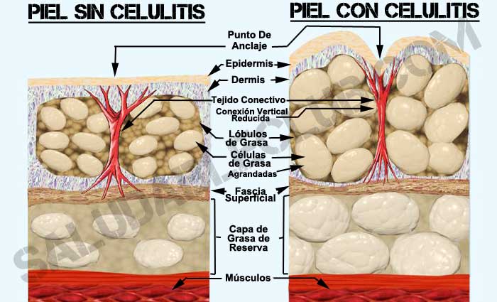 formacion de la celulitis